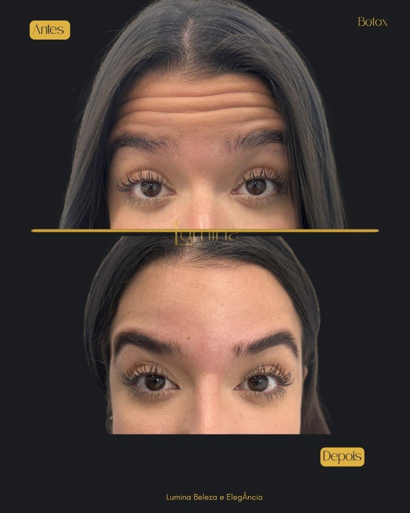 Antes e Depois Botox