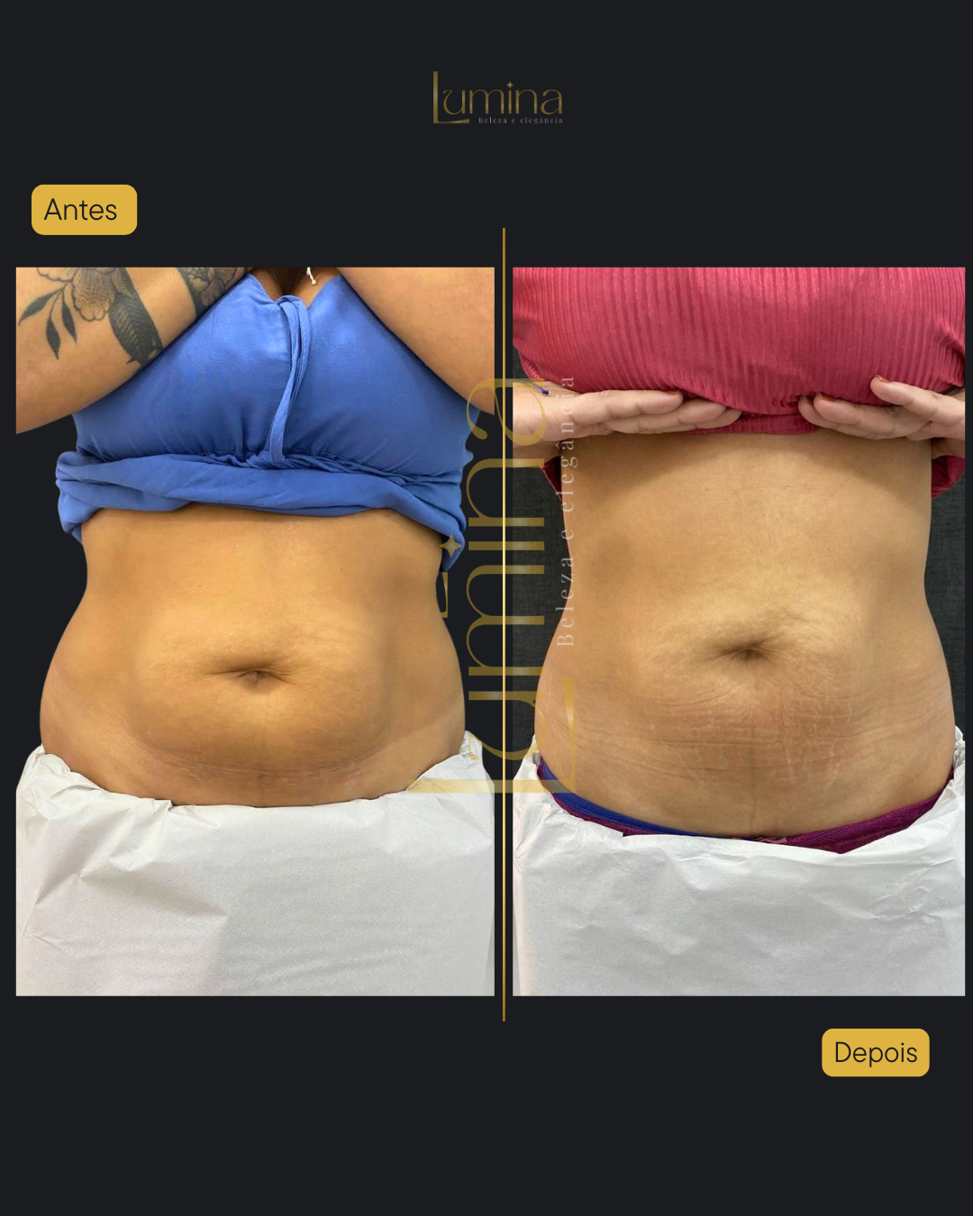 Antes e Depois Modelagem Corporal
