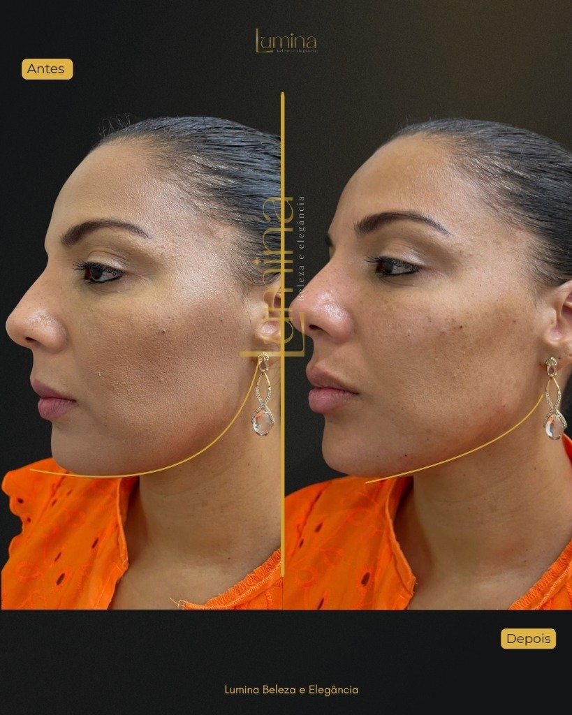 Antes e Depois Harmonização Facial
